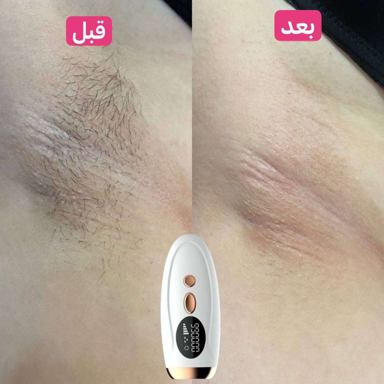 IPL HAIR REMOVAL DEVICE 
الليزر الرهيب 😍 و سعره جداااا مناسب 
تألقي ببشرة صافية ولامعة!
تمتعي ببشرة نظيفة وناعمة دون الحاجة لزيارة مراكز التجميل وإزالة الشعر، مع جهاز ليزر IPL المنزلي لإزالة الشعر بالليزر.#هاشتاكات #اكسبلور_ #newlook #هاشتاكات #هاشتاق #مشاهير #فيديو #انستقرامي #اكسبلوور_طق_فولو #اكسبلور #هاشتاك #ميوزكلي #فيديوهاتي #فولومي #انستقرام #اكسبلورر #اغاني #هاشتاقات #مقاطع #فيديوات #رمزيات #تيك
#تيك_توكر

_


**إذا كنت صاحب هذا الإعلان وتريد حذفه لأي سبب، رجاءا أرسل رسالة إلى الدعم الفني**