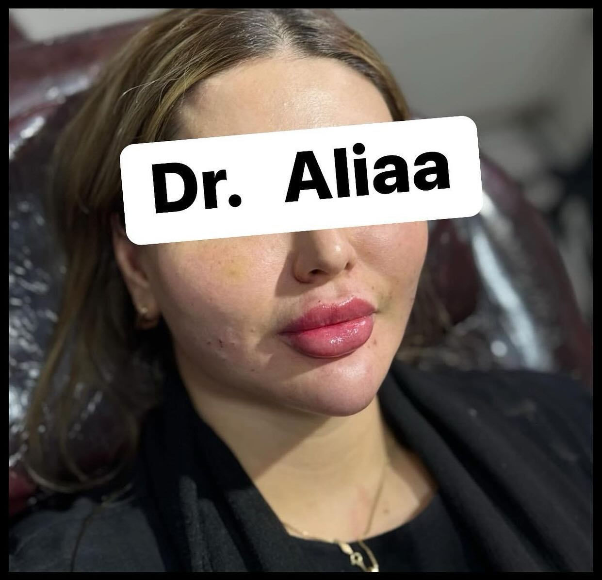 العروض الاقوى في بغداد لجميلات عيادتنة
فيلر الشفاه الكوري💋 50الف فقط  
💉 فيلر تكساس (10 إبر) فقط250 ألف😍  
 إبرة العنبر 10cc* فقط 150 ألف  
👰 إبرة العروسة فقط 50 ألف ❤ 
ابرة الريفتال ب75الف 
⚡ شد الجبين بالبوتوكس فقط 120ألف  
✨شد الوجه بالخيوط غير الجراحية – 8 خيوط
 فقط 300 ألف
فلر بدي ال60سيسي فقط ب500الف 
جلسة معالج الكميائي فقط 75الف 
 

🌸 عرض الصديقات! 😍 
كل 2 صديقات ياخذن فيلر شفة،  
الصديقة الثالثة فيلر شفة + تنظيف بشرة مجاناً!

💆‍♀️تنظيف البشرة العميق الملكي فقط 30 ألف  
🌟 جلسة إزالة الكلف والتصبغات فقط 50 ألف  
(مع جلسة نظارة مجانية)  
👃جلسة تذويب دهون الأنف بدون جراحة فقط 50 ألف
عرض اليزر بجهاز الكاندلا البارد المنطقة فقط15الف 
الفول بدي فقط ب65الف
📍 *الموقع:* بغداد – حي الاعلام  
📞 *للاستفسار:* ***********  
احجزي الآن قبل نفاد المواعيد!

--- ⁩
