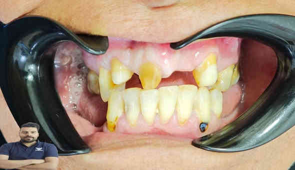 المراجعة جانت مسوية تركيب بغير عيادة فترة وواكع
لان الاسنان كلش تعبانة رجعنة بنينة الاسنان وسوينالهة تركيب سيراميك

العنوان / المسيب / شارع البلدية / مقابل دكتور جعفر وفي للاطفال

للحجز والاستفسار
***********
***********
