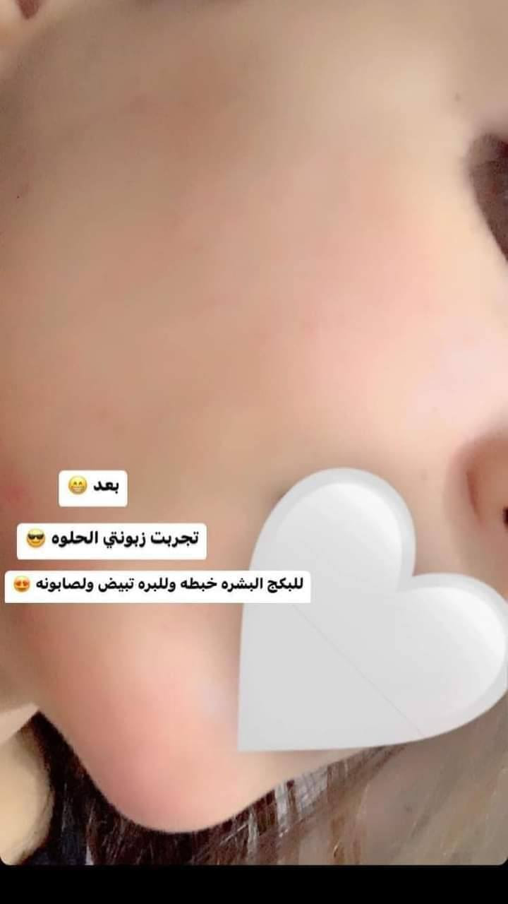 بنات عندي خبطه تبيض الوجه وتوخر النمش والكلف وتنعم البشره
وعندي خبطه تسمين الوجه وتبيض خال 3ايام ولي تحب تجي خاص ا***********
