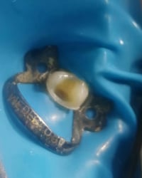 حشوة تجميلية • د مهند الطحان • القياره العام