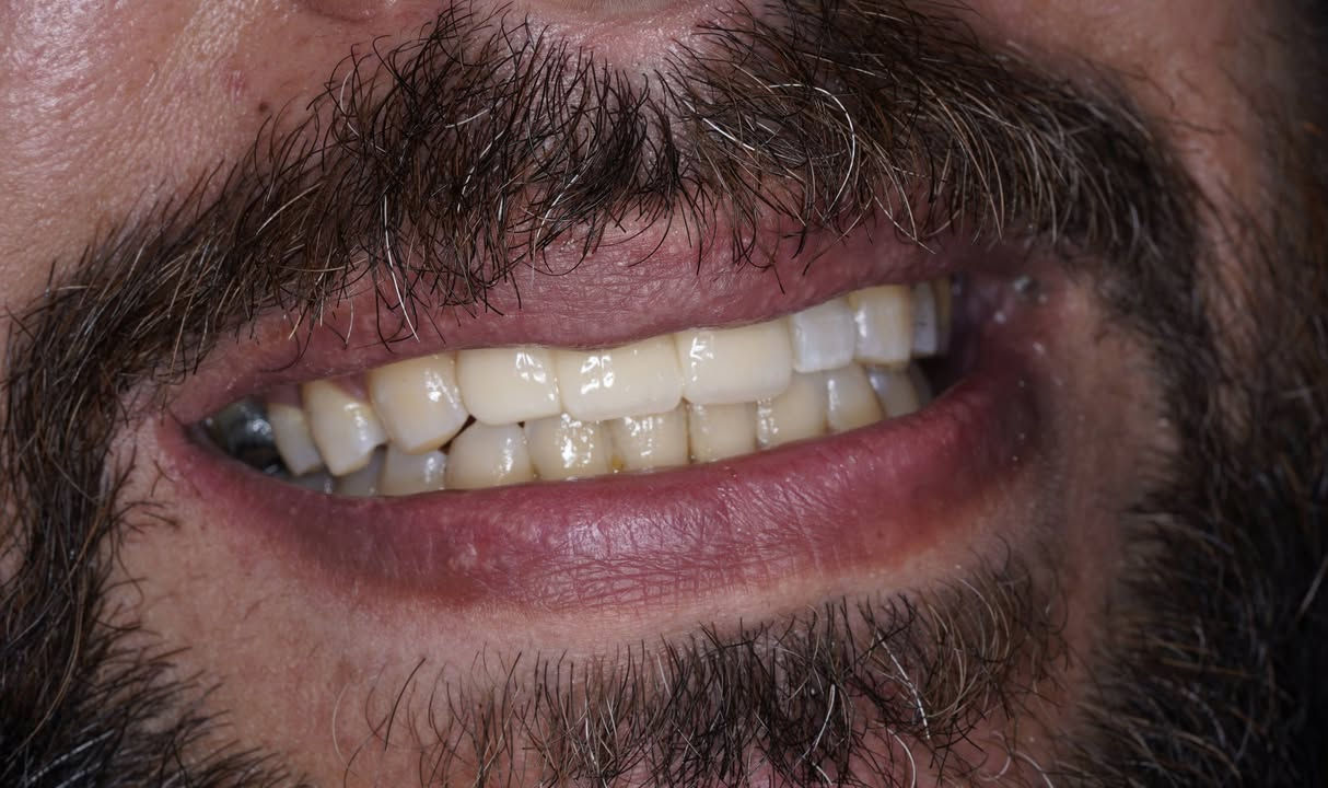 ابتسامة جديدة مراجع يعاني فقدان في سنهة الامامي سوينالة تغليف زاركون بلون مقارب للون الاسنان المجاورة

العنوان / المسيب / شارع البلدية / مقابل دكتور جعفب وفي للاطفال

للحجز والاستفسار
***********
***********
