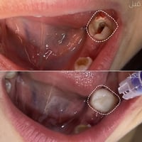 تجميل أسنان • حشوات • بدرة واسط