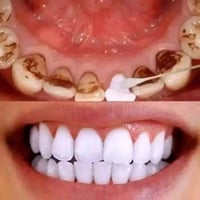 تبييض اسنان • معالج رائحة الفم • مزيل تصبغات