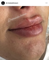 مسويلكم عروض على قسم التجميل في عيادة الدكتورة ميادة حسن لطب وتجميل ال...