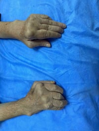 التهاب المفاصل الرثوي • تشوهات اليدين • السماوة