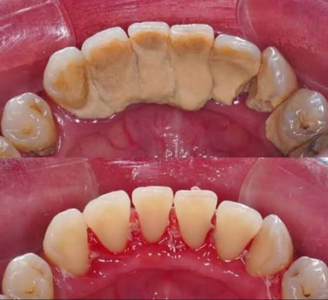 السلام عليكم تعلن عيادات جامعة بابل / كلية طب الاسنان 
إستقبال الحالات التالية  (مجانا) فقط سعر الباص  :
1_قلع الاسنان والجذور التالفه.
2-حشوات دائمية ضوئية وحشوات جذور.
3-تعويض الاسنان المفقودة بطقم كلي 
4-تنظيف الاسنان وازالة التكلسات.
5- معالجة اسنان الاطفال(قلع الاسنان اللبنية/حشوات/تنظيف/وقاية الاسنان من التسوس بإستخدام الفلورايد).
6_  تقويم اسنان متحرك
7_ مشاكل في الفك الصدغي وتقرحات في الفم واللسان 
 للحجز والاستفسار تواصل على الخاص 
او واتساب على الرقم📞 :-  ***********
العنوان🗺 : عيادات طب الاسنان_ حي الاسكان_ قرب الكراج الموحد
