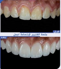 فينير ايماكس • هوليوود سمايل • خانقين