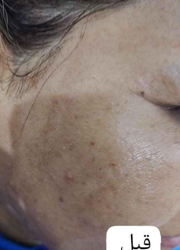 (. ابر )  النضاره النتيجة 😍
ازالة 5 طبقات من الاسمرار من الوجه… .. 
 التبيض الرهيب بنات  ملاحظة استعمال خارجي مو وخز ❤️   يزيل الكلف العميق وتصبغات 
ازالة تجاعيد ازالة الخطوط… . علامات تقدم السن  تستخدم للنساء والرجال ينطي نضاره للبشره توريد لمعه 
أبر لتفتيح ونضارة البشرة ..
التفاصيل راسلني ماسنجر 🌹 بغداد, العراق


**إذا كنت صاحب هذا الإعلان وتريد حذفه لأي سبب، رجاءا أرسل رسالة إلى الدعم الفني**