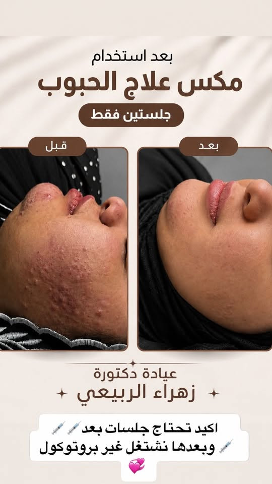 لكل بنات المسيب العروض حصرياً لفرع المسيب
حتى تستفادون منها خصوصا اذا اكو عروسات 🌸
كلش راح تستفادون من العروض لان وياها تنظيف بشرة مجاناً

#تنظيف البشرة بجهاز الهايدروفيشل والسنارة والبخار 🌸

لكثر الطلب على العروض سوينالكم هلمرة عروض غير 💓🌷

يرجى الحجز المسبق على رقم الواتساب مسجات فقط ***********💓👌🏻💐

عيادة الدكتورة زهراء طالب الربيعي 
💓💐
