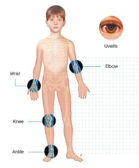 روماتزم الأطفال • أخصائي روماتزم • السماوة