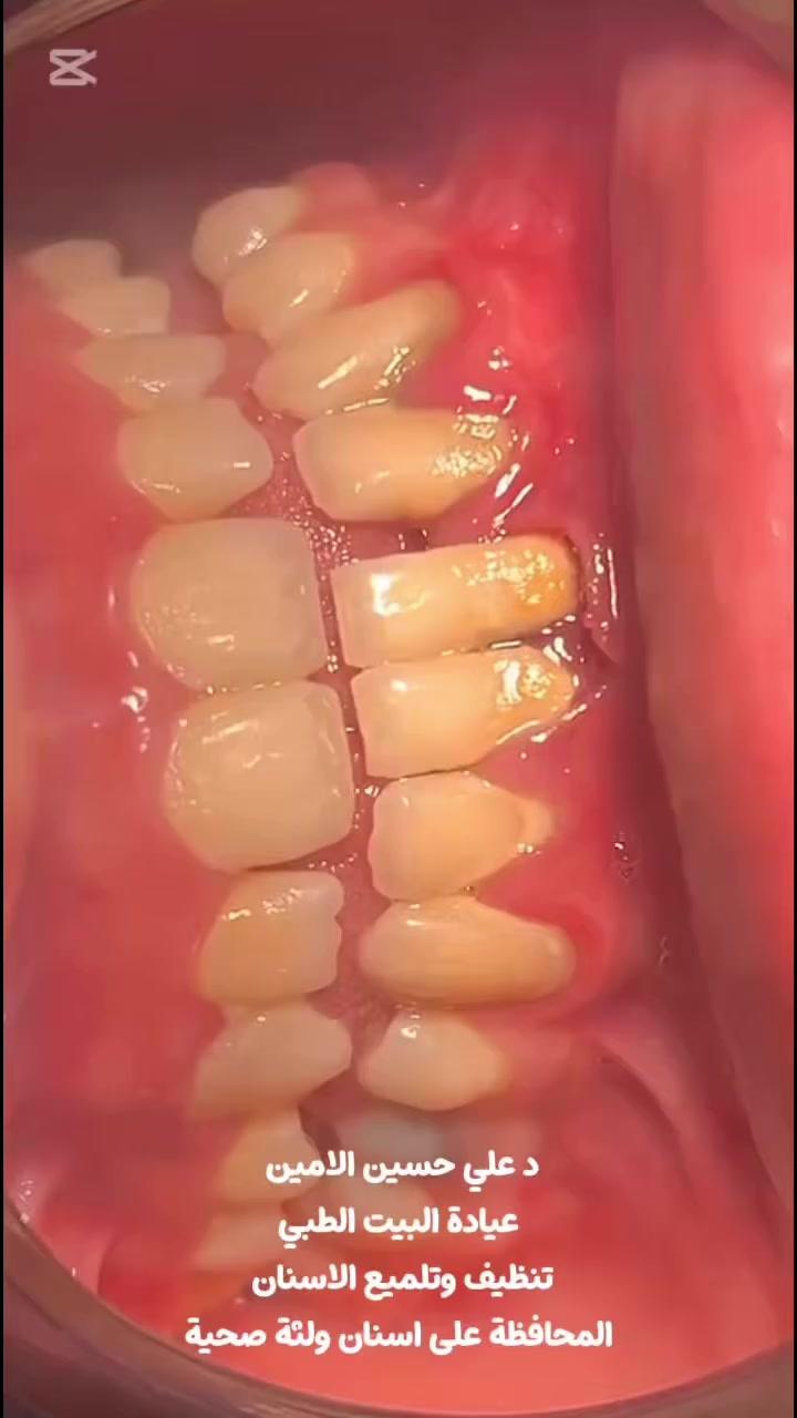 تنظيف أسنان وتلميع ب١٥ الف بس بدل ٢٥ الف

✨ الفرق يبان من أول نظرة!
والصوره تحجيلك عن الشغل وجماله 

إذا أسنانك بيها تصبغات أو جير وتريد ابتسامة أنظف وأجمل، الحل بسيط وسريع 👌

🦷 تنظيف الأسنان وإزالة الجير مع التلميع
يعطيك:
 • أسنان أنظف ولمعة واضحة
 • إزالة التصبغات والتكلسات
 • إحساس بالانتعاش والنظافة

🔥 النتيجة: فرق واضح ومبهر من أول جلسة

📍 في عيادة البيت الطبي
العنوان: بغداد – المحمودية – حي الموظفين – مقابل التانكي 

📅 الحجز *********** من ٣ لل٧
احجز وخلّي ابتسامتك تحچي عنك
