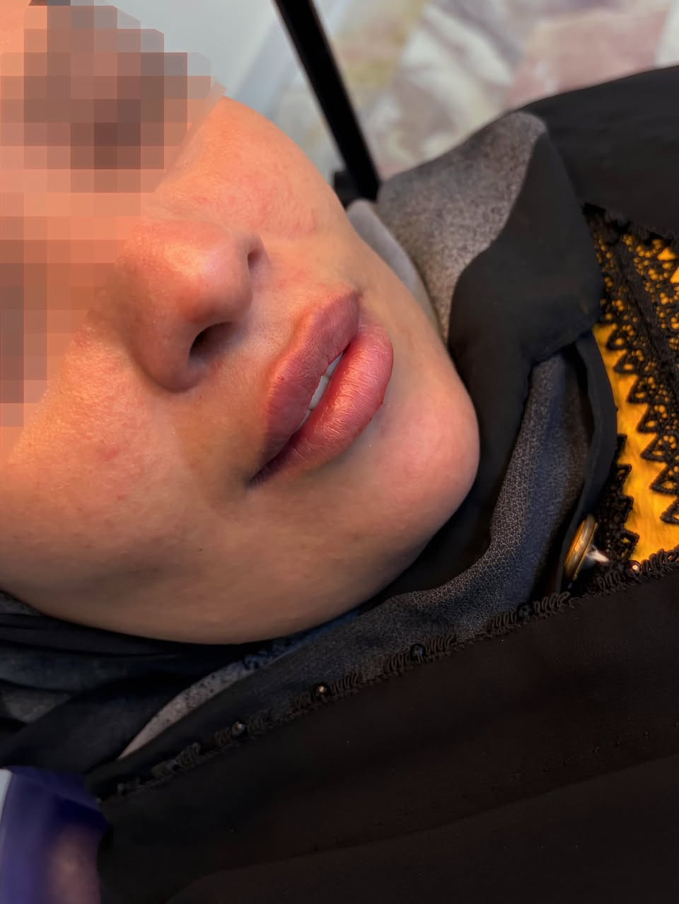 ⁨ وهذا شكل شفايف حبيبتنا الحلوة بعد جلسة الرتوش وخطوتنا القادمة بوتوكس للابتسامة اللثوية ، تكدرون تلاحظون الفرق بين المظهرين ، رغم الصورة فقط شفايف لكن صورة توحي بتقدم العمر وصورة توحي بالشباب ❤️

📍العنوان - الديوانية 
☎️ للحجز او الاستفسار 
  ***********⁩

