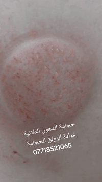 حجامة الدهون • المقدادية حي العصري • عيادة نساء