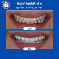 ابتسامة هوليود • فحص مجاني • الكوت الخاجية