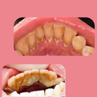 تنظيف تكلسات • مجاني • عيادات بيارق العميد