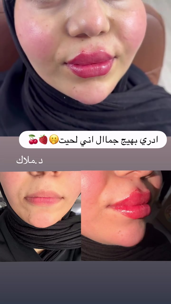 فلر شفه بجمال الرسمه ودقة الشغل 😍#تجميل #بوتوكس_فيلر #اكسبلور #محموديه #اسنان


**إذا كنت صاحب هذا الإعلان وتريد حذفه لأي سبب، رجاءا أرسل رسالة إلى الدعم الفني**