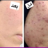 "لا تدعي التصبغات تخفي جمالك، اطلبي كريم التفتيح الآن واحصلي على خصم م...