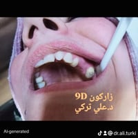 🌺 تركيب أسنان زاركون 💥 في عيادتنا 🏅 د.علي تركي عبادي  💯 للحجز والاتصال...