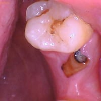 قلع اسنان • سن عقل جراحياً • الحله شارع ٤٠