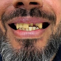 ابتسامة هوليوود • زركون إيماكس • ضمان مدى الحياة