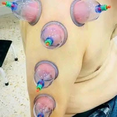 ♦️ التنويع في مواضع الحجامة … سرّ النتائج الأفضل ♦️
ليست الحجامة موضعًا واحدًا فقط ، بل هي علمٌ قائم على اختيار المكان المناسب حسب الحالة ، وكل موضع له تأثير خاص على الجسم .

🔹 الحجامة على الرقبة والرأس :
✔ تخفيف الصداع المزمن
✔ تقليل التوتر والقلق
✔ تحسين التركيز وصفاء الذهن
✔ تنشيط الدورة الدموية في الدماغ

🔹 الحجامة على الظهر :
✔ تخفيف آلام الظهر والكتفين
✔ تنشيط الدورة الدموية العامة
✔ تحسين عمل الجهاز العصبي
✔ تقوية الجسم واستعادة النشاط

🔹 الحجامة على البطن والصدر :
✔ تحسين الهضم وعلاج القولون والخلعة 
✔ تخفيف الانتفاخ والغازات
✔ دعم عمل الجهاز التنفسي
✔ تنظيم بعض وظائف الجسم الداخلية

🔹 الحجامة على الأطراف العلوية :
✔ تخفيف آلام الذراعين والمفاصل
✔ تحسين تدفق الدم لليدين
✔ تقليل التنميل والخدر

🔹 الحجامة على الأطراف السفلية :
✔ تحسين الدورة الدموية في الساقين
✔ تخفيف آلام الركب والمفاصل
✔ تقليل الثقل والتعب في الأرجل

✨ التنويع في مواضع الحجامة يعطي نتائج أدق وأفضل حسب حالة كل شخص .

العنوان : ابو غريب العمارات السكنيه عماره ٧ على ١٠
📞 الهاتف ***********
***********
#يتوفر_لدينا_كادر_نسائي_متخصص
