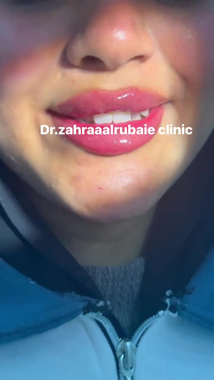 جمال مراجعاتنا 💞💞

سوت فلر شفه + ذقن وحصلت على نضاره مجاناً

للحجز والاستفسار عن العروض يرجى مراسلتنا واتساب***********للحجز المسبق
طبيبتنا من بغداد تتواجد فقط على الحجوزات ✅
عنواننا المسيب شارع البلدية عيادة الدكتورة زهراء الربيعي
