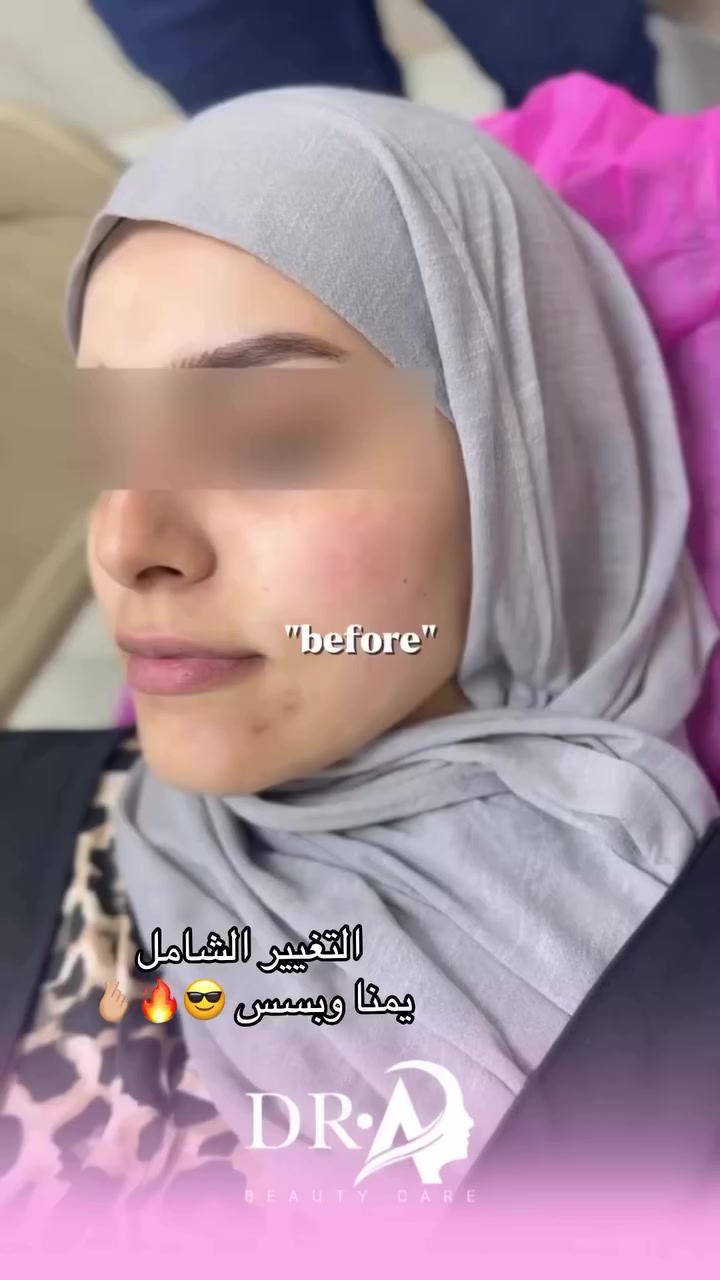 التغيير الشامل🫰🏼
مو بس نغير ملامحك .. نبرز جمالك الحقيقي بأيد دكتور احمد عبد الرحيم 🤍

إذا تحسين ملامحك تحتاج توازن، تحديد، أو لمسة أنثوية ناعمة
التغيير الشامل راح يعطيك نتيجة مرتبة وطبيعية بدون مبالغة 🌸

💉 يشمل:

 •تحديد الفك والذقن
 •إبراز الخدود
 •تعديل الشفايف
 •تحسين تناسق الوجه كامل

🎯 النتيجة:
وجه متناسق + ملامح أوضح + ثقة أعلى 🫰🏼

للحجز والاستفسار 
***********
***********

العنوان: مركز الدكتور عبد الرحيم الشماع
النـجف_المناذرة ( ابو صخير)
شارع مستشفى المناذرة العام 
قرب مقر حزب الدعوة⁩⁩
