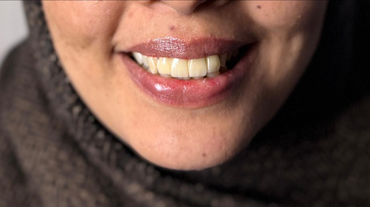 مو كل ابتسامة تنولد صح… بس الصح نعرف شلون نصلّحها 😌🦷

مراجعتنا جانت تعاني من تركيب أسنان سابق خطأ
❌ عدم تطابق
❌ صفر بالأسنان
❌ كسر وتشوه بالشكل
❌ ابتسامة مو مريحة لا نفسياً ولا شكلياً

📌 استلمنا الحالة من البداية
• شلّينا التركيب القديم بالكامل
• قيّمنا الحالة بدقة
• سوّينا تركيب جديد مدروس صحياً وجمالياً
• ركزنا على التناسق، الراحة، والابتسامة الطبيعية

✨ النتيجة؟
ابتسامة مرتّبة، ناعمة، وتفتح النفس
تركيب يليق بالوجه… مو مجرد أسنان!

💡 لأن الفرق مو بالتركيب
الفرق بالخبرة، التشخيص الصح، والشغل النظيف

📍 إذا عندك تجربة سابقة فاشلة
📍 إذا خايف/ة تعيدين الغلط
📍 إذا تريد ابتسامة ترجع ثقتك بنفسك

احنا هنا حتى نصلّح مو نجرّب ✔️

📞 للحجز والاستفسار:***********
📩 راسلينا خاص

#تصحيح_تركيب
#ابتسامة_تفرق
#طب_الأسنان
#حالات_قبل_وبعد
#ثقة
#SmileMakeover
#DentalCare
