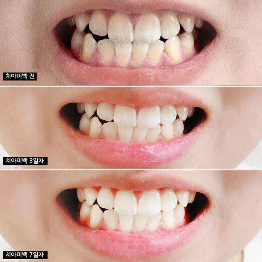 معجون أسنان مُبيّض فعّال، ذو تأثير  منعش قوي بنكهة البرقوق والنعناع

يحتوي على تركيز آمن من بيروكسيد الهيدروجين، الذي تذيب فقاعات الأكسجين البقع الداكنة على سطح الأسنان، مُوفَرًا بذلك أفضل تأثير تبييض

يُفتح تصبّغات الأسنان بفعالية، ويُزيل البلاك والجير وبقايا الطعام والروائح الكريهة بفعالية ويوفر حماية تدوم ۱۲ ساعة من رائحة الفم الكريهة

يمنع تراكم الجير، والتهاب اللثة، وأمراض اللثة، ويحافظ على بياض الأسنان وقوتها، ونظافة تجويف الفم يُنعش الأسنان ويُحسّن مظهرها الجمالي من خلال منع تسوس الأسنان

تصل الحماية ضد البكتيريا المسببة لرائحة الفم الكريهة

المكونات الرئيسية

ثاني أكسيد السيليكون : وقائي ممتاز لالتهاب اللثة ويقوي الأسنان ولا يضر مينا الأسنان، بل ينظفها ويصقلها بفعالية

مستخلص الصبار : المعروف بخصائصه العلاجية، له تأثير وقائي ضد التسوس، يرطب تجويف الفم، ويقلل الالتهاب ويهدئ اللثة المتهيجة، ويقلل خطر الإصابة بأمراض الفم

مستخلص الشاي الأخضر : له خصائص قوية مضادة للالتهابات ومضادات الأكسدة

الجلسرين : مُطهّر ومضاد للالتهابات، يساعد على تخفيف التورم والألم في اللثة كما يُساعد الجلسرين على الحفاظ على نظافة الفم، مما يُقلل من خطر تسوس

الحجم 100 غم
صنع في كوريا


**إذا كنت صاحب هذا الإعلان وتريد حذفه لأي سبب، رجاءا أرسل رسالة إلى الدعم الفني**