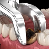 قلع اسنان • مجاني • جامعة كربلاء