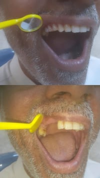 اللي فاقد جزء من أسنانه مثل اللي بالصور ويحتاج تعويض بطقم أسنان جزئي م...