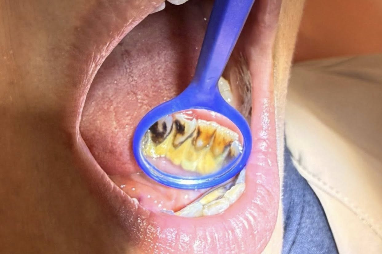 السلام عليكم 
متوفر علاج مجاني من تنظيف الاسنان او حشوه ضوئيه للاسنان المتسوسه وقلع للجذور المتبقيه وطقم اسنان 
الموقع عيادات جامعة الفراهيدي
للتواصل ***********
