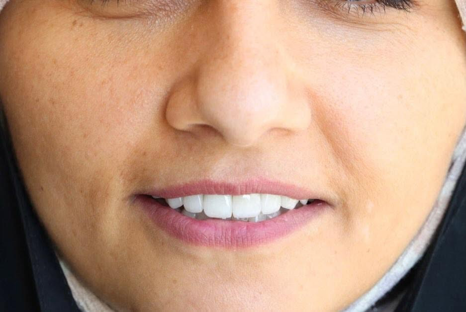 تغليف الأسنان مو بس يحسن شكل السن🦷✨
 إنما يعيد القوة والثقة بالابتسامة..
في عيادتنا نوفر تغليف أسنان بدقة عالية ومواد ذات جودة ممتازه حتى تحصل على ابتسامة طبيعية ومميزة تدوم لسنوات🤍

متواجدين طيلة ايام  الاسبوع 
نستقبلكم بكل حُب♥️
العنوان : الديوانية/ تحت الجسر المعلق / بناية فندق الديوانية سابقًا / مقابل المحافظة

للحجز والاستفسار ***********
***********
