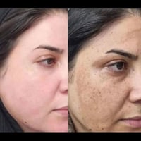 كلف • بشرة تعبانة • بشرة • عناية بالبشرة • مستحضرات تجميل • علاج كلف •...