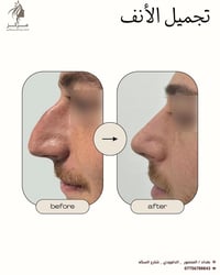 "عمليات تجميل الانف بلبنج العام ✨🤍🤍🤍🤍🤍  بأشراف افضـل اطـباء الجراحة وا...