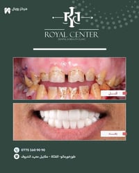 إعادة تأهيل أسنان • تجميل ابتسامة • طوزخورماتو