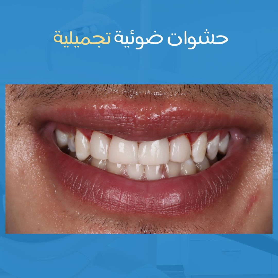 ✨ حشوات تجميلية للأسنان الأمامية ✨

تم إجراء حشوات تجميلية للأسنان الأربعة الأمامية
بدقة عالية ومواد متطورة
لإعادة الشكل الطبيعي واللون المتناسق
والحصول على ابتسامة ناعمة وقريبة من الأسنان الأصلية 🦷🤍

النتيجة:
تحسين فوري بالشكل، وثقة أكبر بالابتسامة ✨

📍 السماوة – الإسكان – مقابل كافتيريا كناري
📞 ***********
⏰ الدوام من 3 عصراً إلى 10 مساءً – طوال أيام الأسبوع
