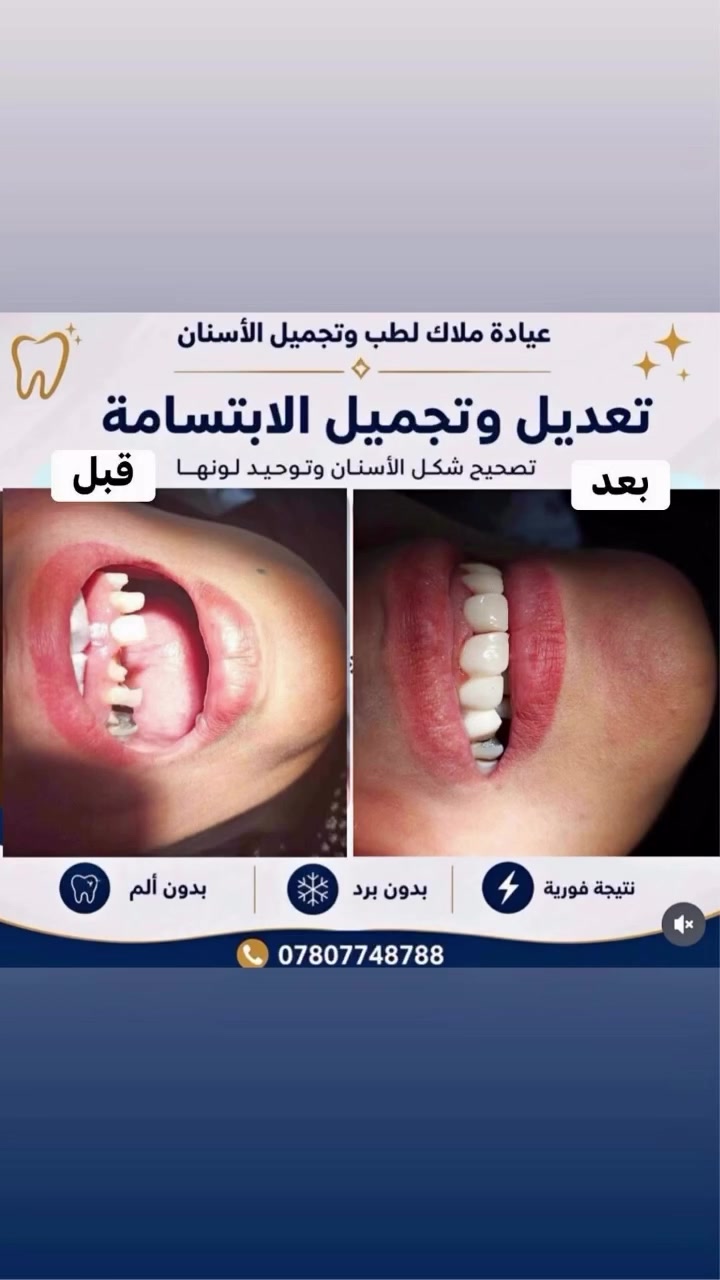 � من حالة فقدان وتلف الأسنان إلى ابتسامة متكاملة وطبيعية.

في هذا العمل تم:
✅ تقييم الحالة ووضع الخطة العلاجية المناسبة
✅ زراعة الدعامات (المرابط) بدقة عالية
✅ تركيب الأسنان النهائية بأفضل الخامات
✅ استعادة الشكل الجمالي والوظيفة الطبيعية للأسنان

🌟 النتيجة:
ابتسامة طبيعية، مظهر أجمل، وثقة أكبر بالنفس.

نحرص في عيادة ملاك على تقديم أحدث التقنيات وأفضل الحلول العلاجية والتجميلية للحصول على نتائج تدوم وتمنحك الراحة والرضا.

📍 عيادة ملاك لطب وتجميل الأسنان
📞 ***********

#زراعة_الأسنان #تركيبات_الأسنان #تجميل_الأسنان #ابتسامة_هوليود #عيادة_ملاك طب_الأسنان ابتسامة
