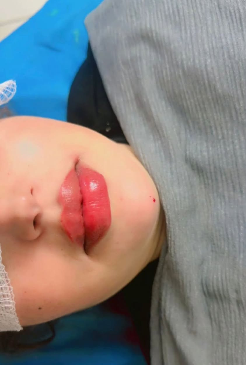 حقن فلر الشفاه👄 بطريقة ناعمة لمراجعتي الجميلة 
 
الهدف من الحقن💉إبراز الجمال الطبيعي وليس تغييره ❤️‍🔥

ميرو للَتجْميل واللَيزَرْ
للحجز والاستفسار :***********
ميرو للَتجْميل واللَيزَرْ
بنات تعير يجنن
@إشارة
