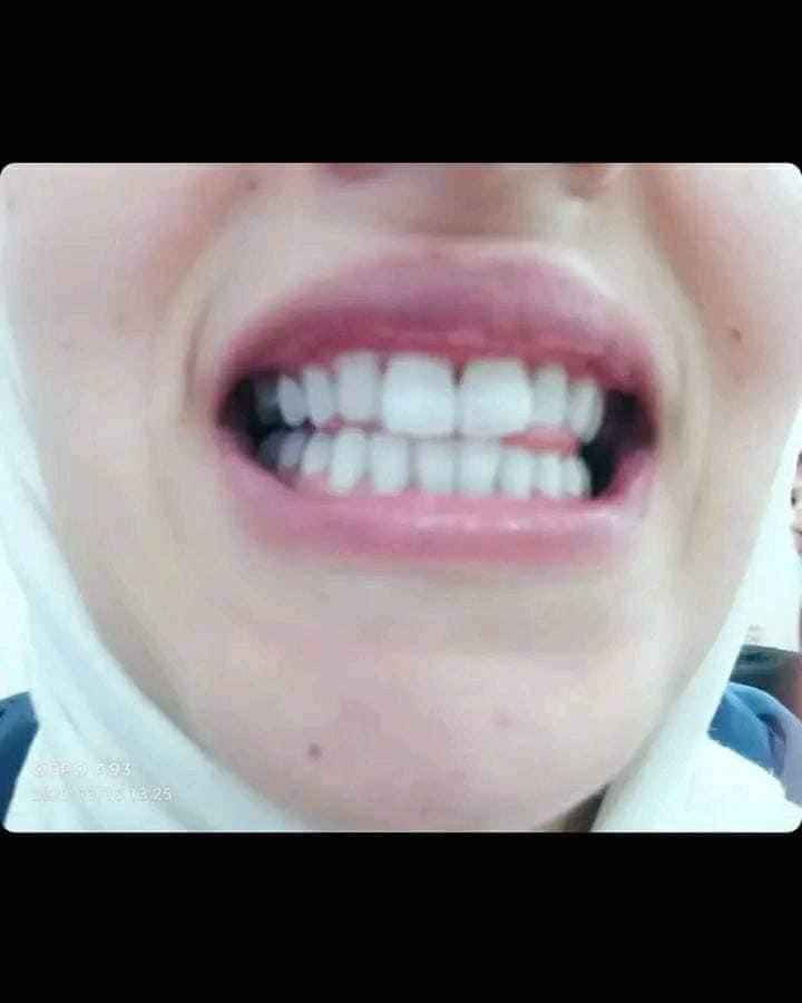 قطرات تبييض الاسنان من   Lanben
 الي يعاني من صفار أسنانه او البقع من كثرة التدخين او شرب الشاي والقهوة والمواد الصبغية 
وحاب يرجع اسنانه بيض انصحك بأستخدم منتج لانبينا للتبييض الأسنان ومن اول استعمال
أسرع مبيض اسنان على الإطلاق يزيل الاصفرار 
❤رجع لمعان ابتسامتك بلحظات  
❤مضمون 100%
السعر خاص بغداد, العراق


**إذا كنت صاحب هذا الإعلان وتريد حذفه لأي سبب، رجاءا أرسل رسالة إلى الدعم الفني**