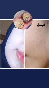 تبيض • نضارة • اثار حبوب