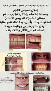 تعويض الاسنان • علاج مجاني • جامعة البصرة