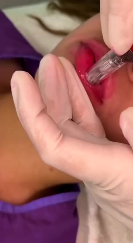 وفرنا لكم بكج جهاز ديرمابن اينزو 💯 الاصلي الايطالي💯
جهاز الديرمابن من Enzo ❤❤

ديرما بن هو العلاج النهائي لحفر الوجه والندبات للحصول على النضارة وتحسين مظهر الجلد، 
 يحتوي على مجموعة من الإبر الدقيقة التي تساعد على تجديد حيوية البشرة من خلال تحفيز إنتاج الكولاجين. حيث يساعد ذلك على تنشيط الدورة الدموية داخل أنسجة البشرة، كما يساعد على شد الجلد المترهل، إصلاح الخلايا التالفة واستعادة نضارة البشرة
 
💫استخدمات الديرمابن 💫

عادة ما يستخدم ديرما بن للوجه لعلاج المشكلات الجلدية الشائعة والتي من بينها:

✔التخلص من آثار التقدم بالعمر على البشرة
✔تجديد خلايا البشرة وجعلها نضره 
✔تحسين ملمس الجلد
✔ازالة التصبغات والبقع الداكنه
✔ علاج الندوب واثار حب الشباب .
✔علاج الندبات الناتجة عن العمليات الجراحية
✔الخطوط الرفيعة والتجاعيد .
✔تضييق المسام الواسعة .
✔ شحوب الوجه .
✔التشققات الجلدية
✔️ مع امبولة ميزو وايت لتبييض البشرة
✔️ وامبولة ميزو وايت توريد الشفه 
الاصلي الايطالي🇮🇹🇮🇹


**إذا كنت صاحب هذا الإعلان وتريد حذفه لأي سبب، رجاءا أرسل رسالة إلى الدعم الفني**