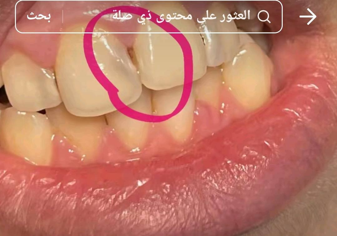 السلام عليكم ورحمه الله وبركاته
الي عندة تسوسات بأسنانه تشبه هاي الصور او كسر بلأسنان الامامية يراسلني على هذا الرقم واتساب ***********علما بأن العلاج مجاني وبأشراف دكاترة مختصين وبعيادات نظيفة تضمن راحة المريض
