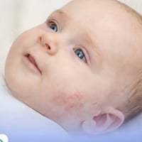 حساسية بروتين حليب البقر (CMPA) لدى الأطفال 👶🍼 ​تُعد حساسية بروتين حلي...