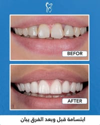 عيادة أسنان • زراعة أسنان • مركز البصرة التخصصي