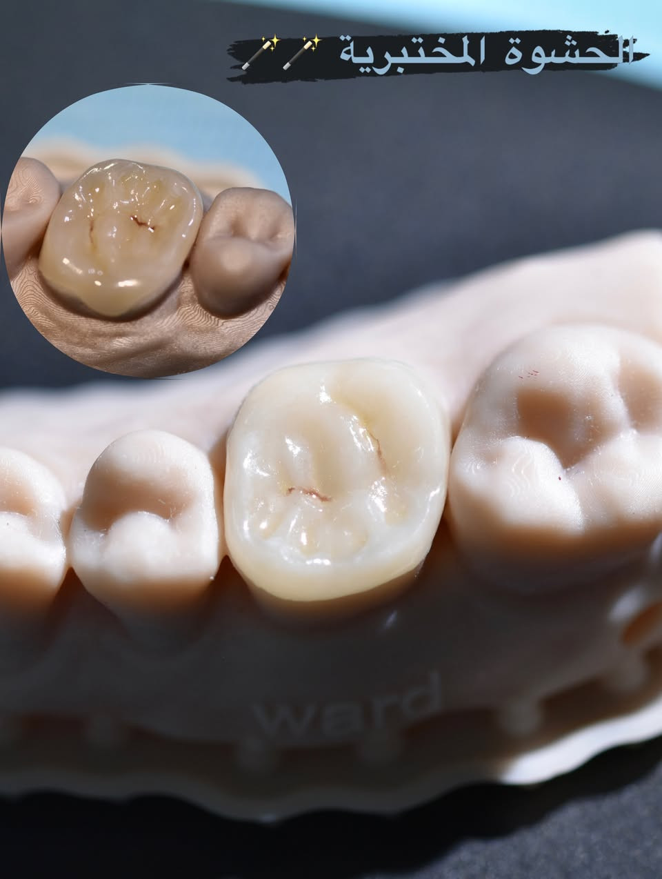 حشوة مختبرية 🦷🪄🫧🌸
.
.
.
.
#حشوة_مختبرية #حشوة_ضوئية #ابتسامتك_أجمل #ابتسامة_طبيعية #صحةالأسنان


**إذا كنت صاحب هذا الإعلان وتريد حذفه لأي سبب، رجاءا أرسل رسالة إلى الدعم الفني**