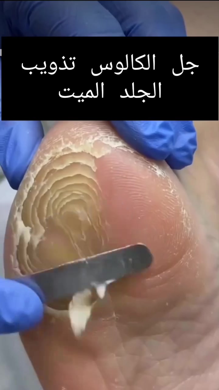 👣✨ وداعاً للجلد الميت والخشونة
مادة الكالوس للعناية بالقدمين ونتائج تفرق من أول استخدام 😍

🚚 توصيل لجميع المحافظات

للطلب راسلينا خاص 📩


**إذا كنت صاحب هذا الإعلان وتريد حذفه لأي سبب، رجاءا أرسل رسالة إلى الدعم الفني**