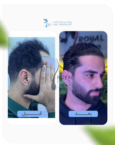 بعد ٩ أشهر من زراعة الشعر… ظهر الفرق الحقيقي.
من مرحلة التراجع والخطوط المرسومة، إلى شعر متناسق، طبيعي، وكثافة تثبّت الثقة قبل الشكل.
إحنا في رويال هير نشتغل على نتيجة تبقى، وعلى تفاصيل تنطيك مظهر يناسبك ويشبهك.
خط شعر محسوب، توزيع دقيق، وكثافة تبهر… وهذا مجرد مثال من مئات النتائج اللي نفتخر بيها يوميًا.

العنوان بغداد المنصور شارع الاميرات مجاور مطعم ست الشام بناية جود سنتر ط٢ 
***********
